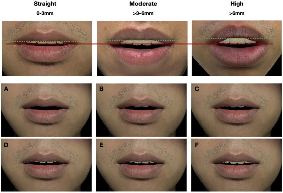 What surgery should I get for my jaw — before and after photo — Cosmetic Surgery on GlowUps