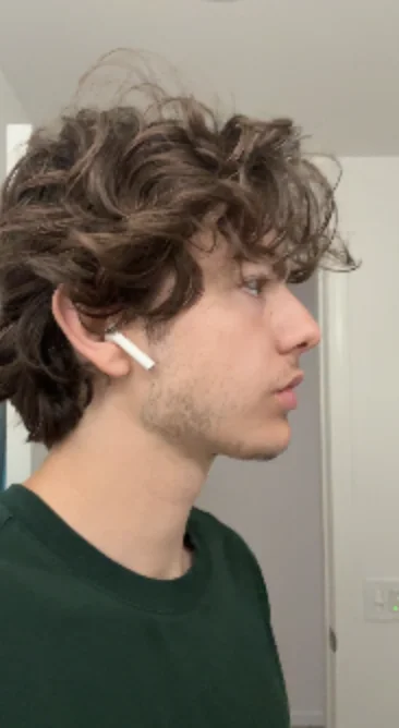 What surgery should I get for my jaw — before and after photo — Cosmetic Surgery on GlowUps