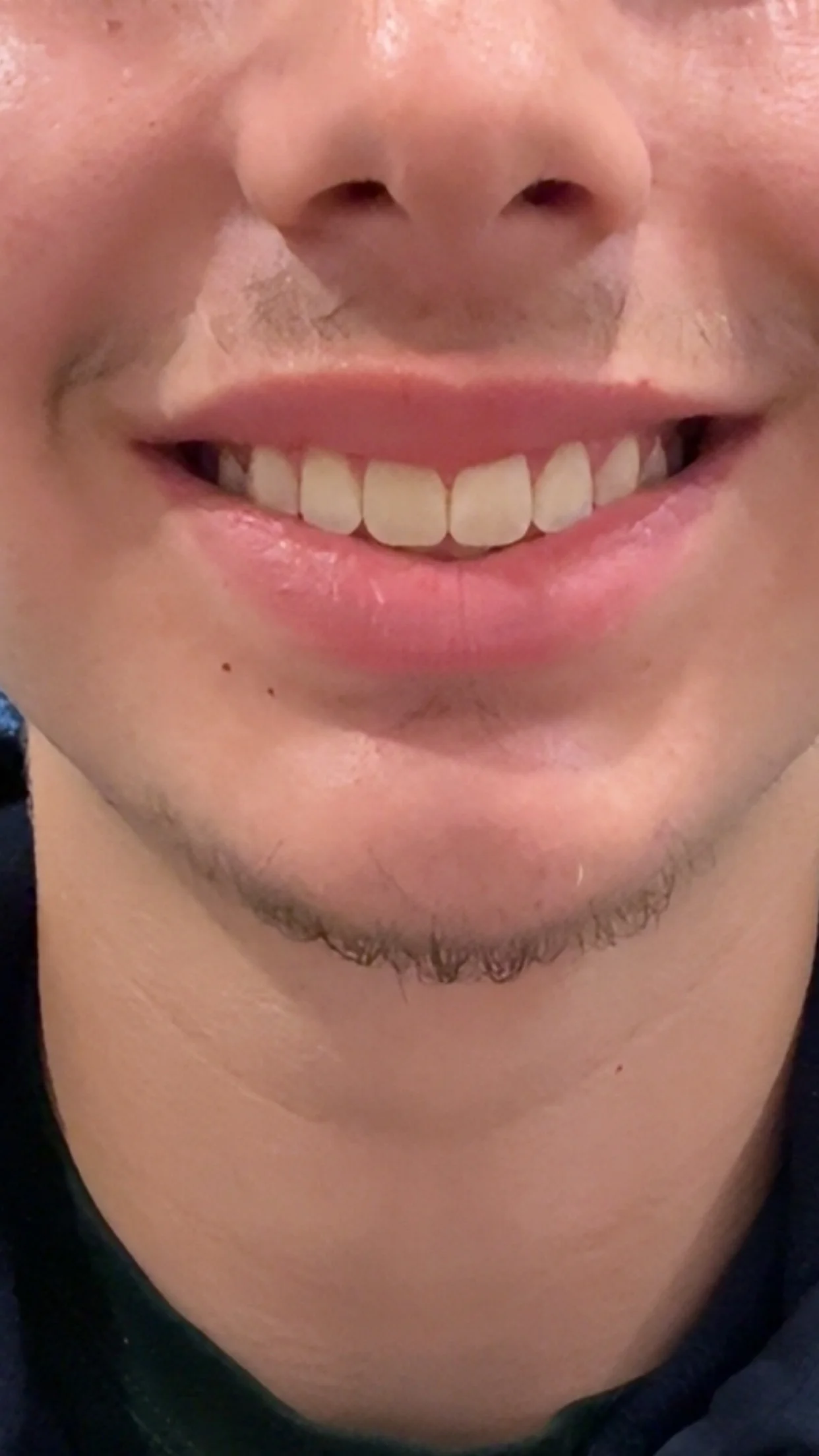 What surgery should I get for my jaw — before and after photo — Cosmetic Surgery on GlowUps