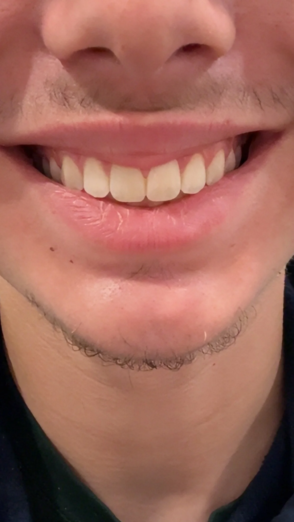 What surgery should I get for my jaw — before and after photo — Cosmetic Surgery on GlowUps