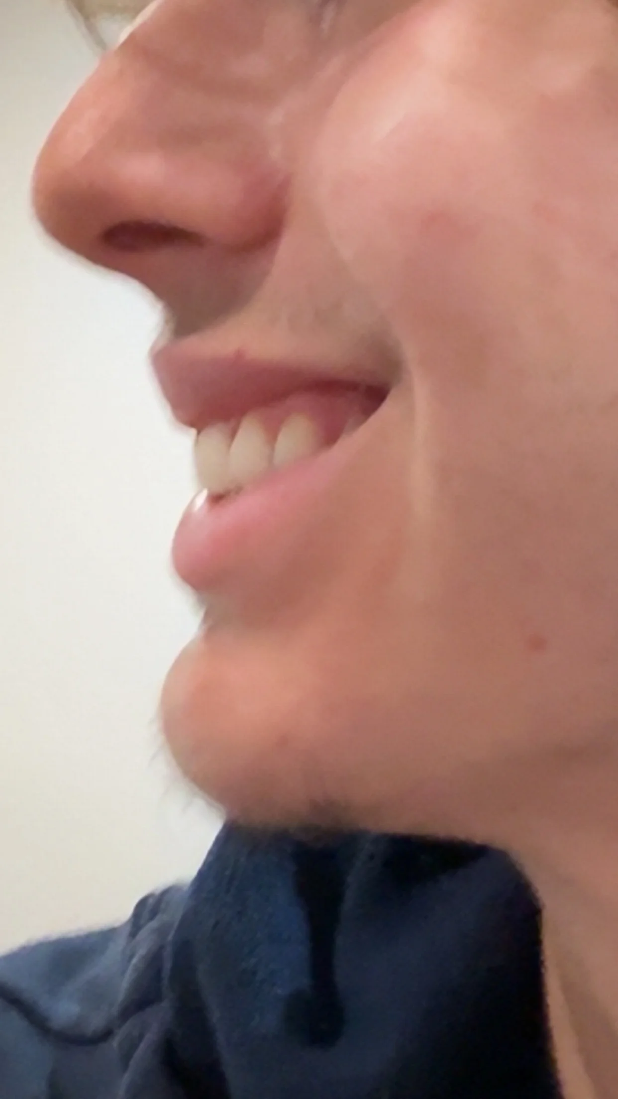 What surgery should I get for my jaw — before and after photo — Cosmetic Surgery on GlowUps