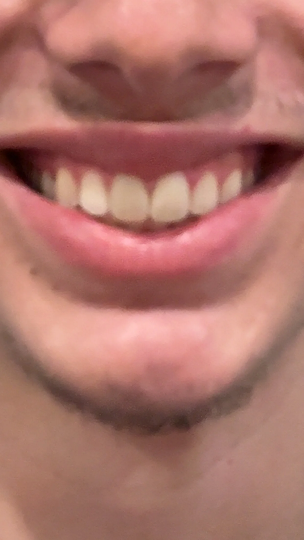 What surgery should I get for my jaw — before and after photo — Cosmetic Surgery on GlowUps