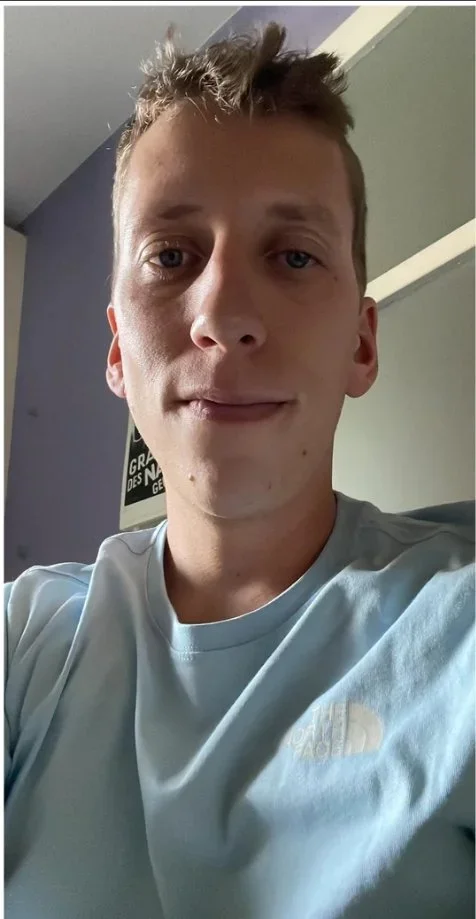 Double Jaw Surgery + Genioplasty — before and after photo — Cosmetic Surgery on GlowUps