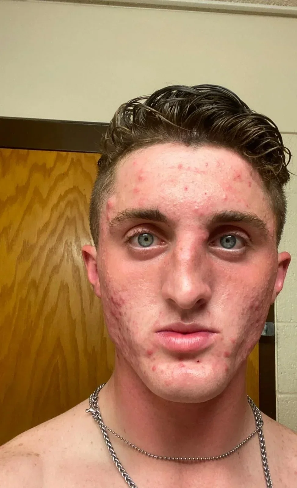 Accutane saved me [19 to 23] — before and after photo — General Glowups on GlowUps