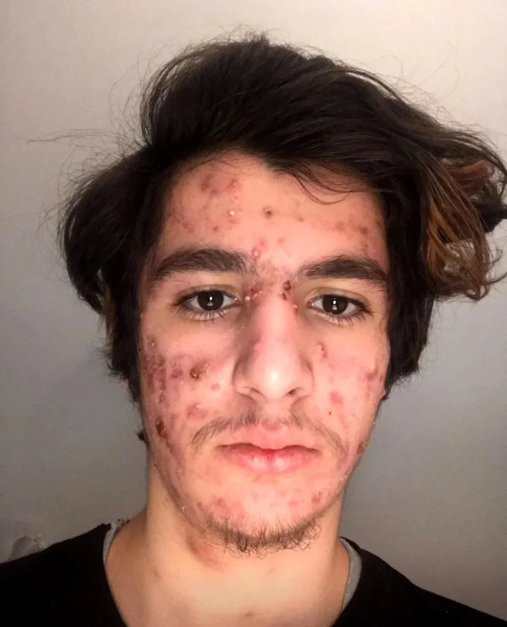 Accutane treatment and gym — before and after photo — General Glowups on GlowUps