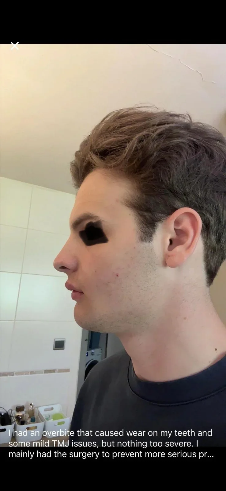 3 Weeks Post Lower Jaw Surgery — before and after photo — Cosmetic Surgery on GlowUps