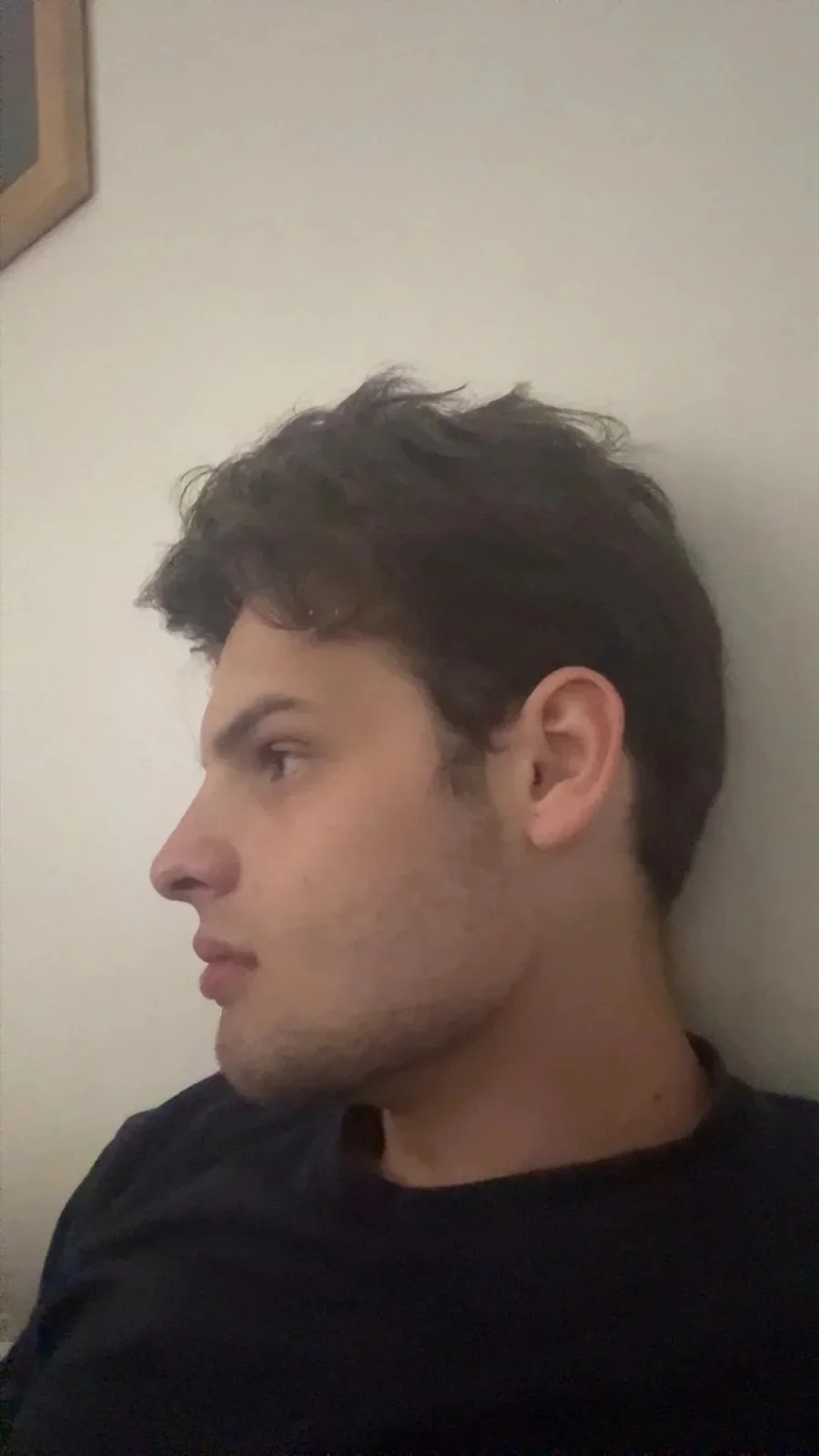3 Weeks Post Lower Jaw Surgery — before and after photo — Cosmetic Surgery on GlowUps