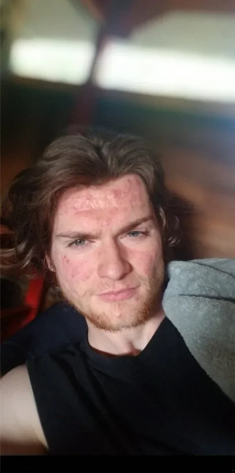 Accutane + fat loss progress — before and after photo — General Glowups on GlowUps
