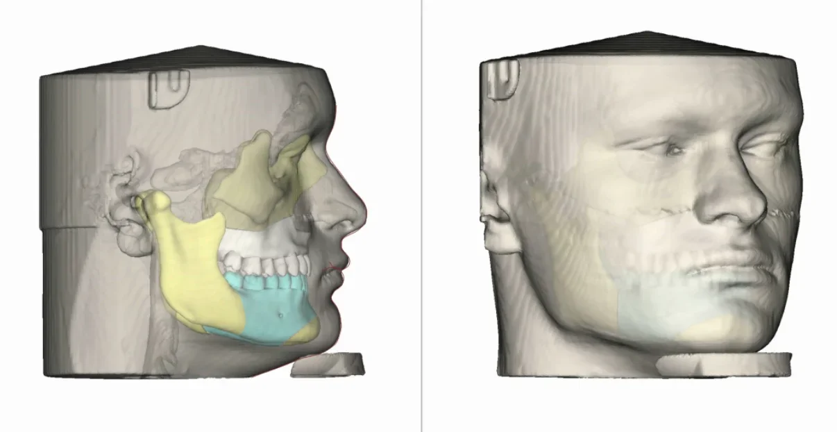 Trimax jaw surgery with Dr Valerio Ramieri + 8 years of lifting — before and after photo — Cosmetic Surgery on GlowUps Trimax jaw surgery with Dr Valerio Ramieri + 8 years of lifting — before and after photo — Cosmetic Surgery on GlowUps