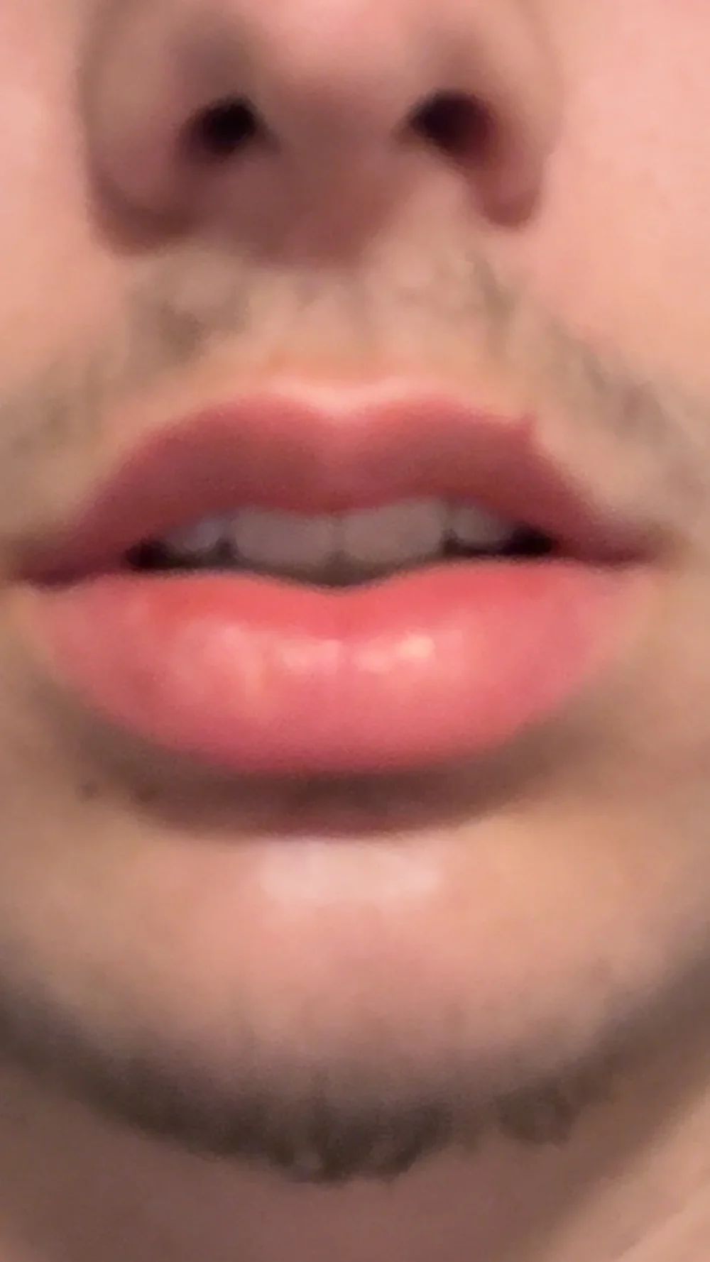 What surgery should I get for my jaw — before and after photo — Cosmetic Surgery on GlowUps